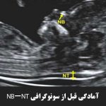آمادگی قبل از سونوگرافی NB-NT