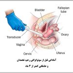 آمادگی قبل از سونوگرافی رحم، تخمدان و حاملگی کمتر از 3 ماه
