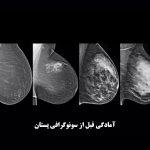آمادگی قبل از سونوگرافی پستان